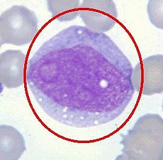 ="/item/细胞">细胞 /a>增多症(infectious mononucleosis)是由ebv a