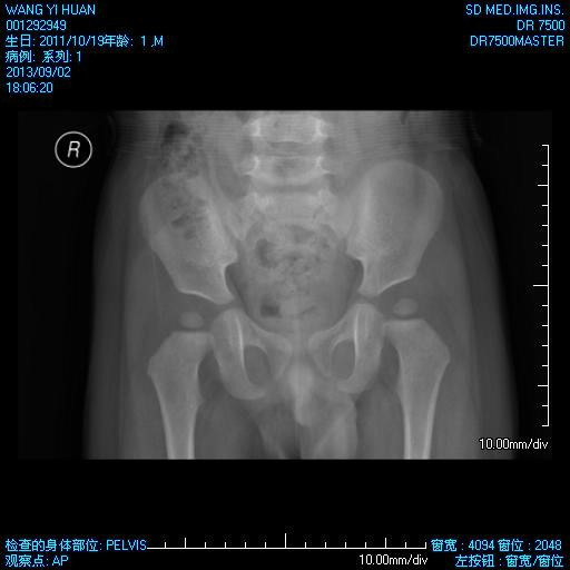  p>发育性髋关节发育不良(ddh)又称发育性髋关节脱位,是儿童骨科最