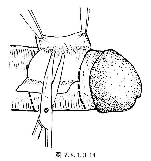 环切包皮