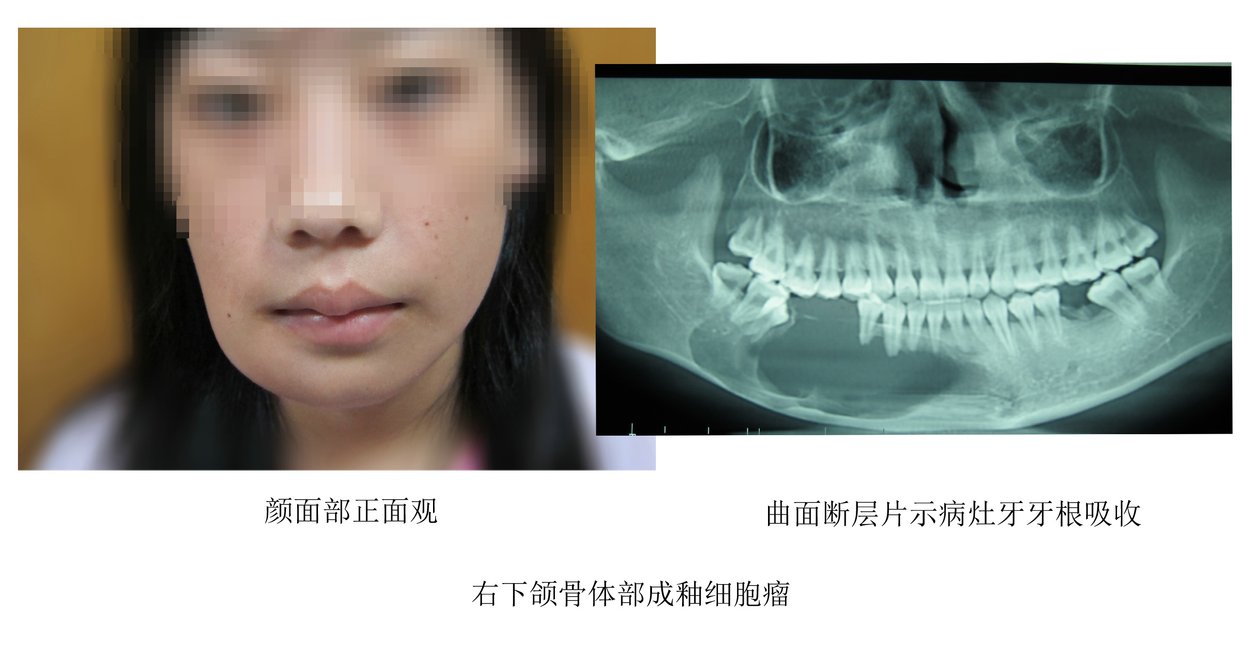 成釉细胞瘤