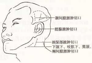 口腔颌面部蜂窝织炎