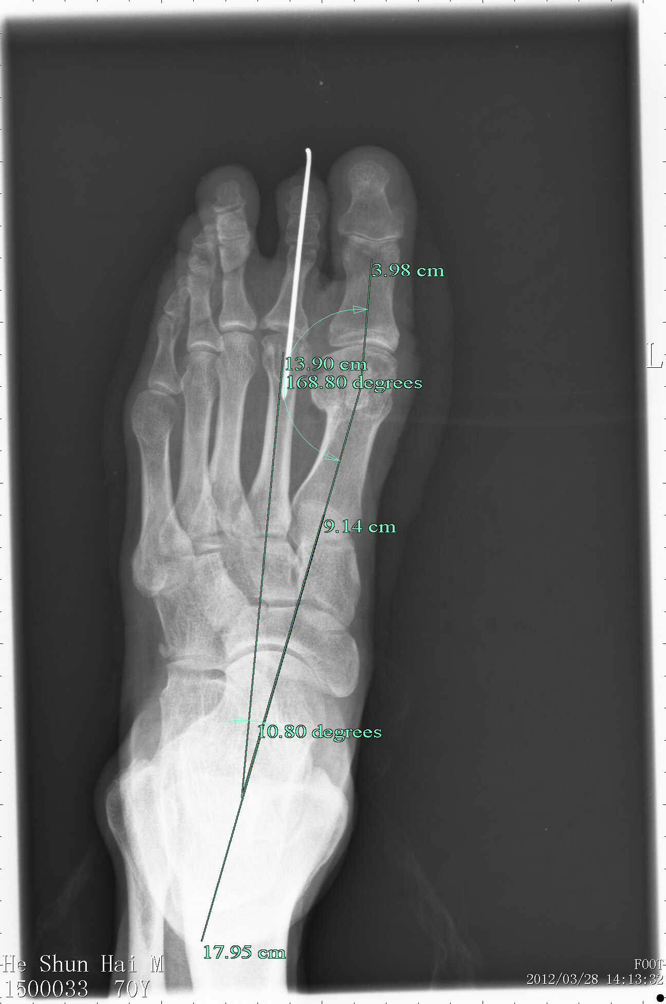  p data-id="sovgmno7zfeo">跖趾关节属椭圆关节,可作屈伸及轻微的收