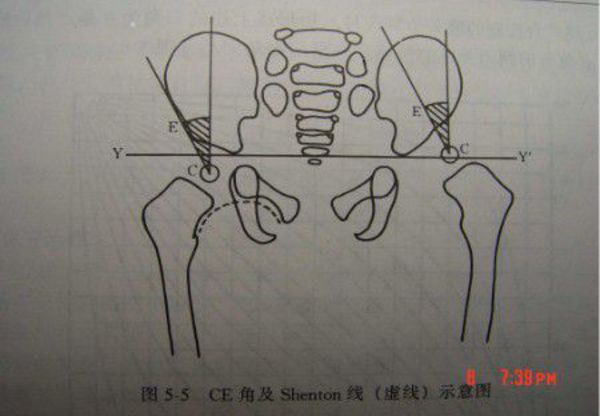 髋关节发育不良