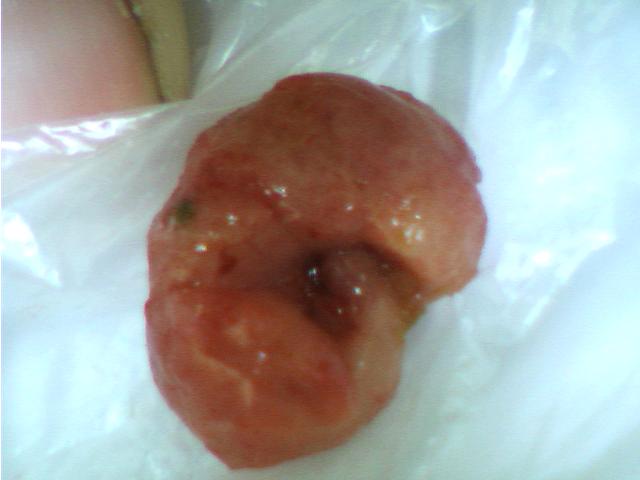 管状腺瘤