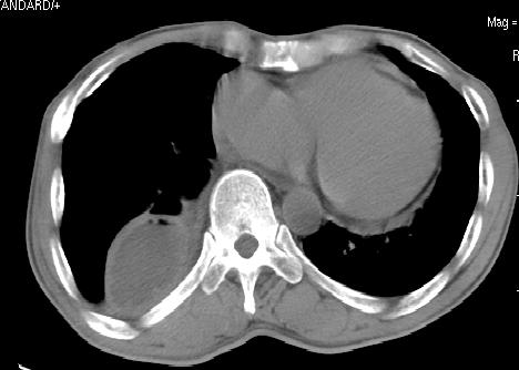 包裹性胸腔积液