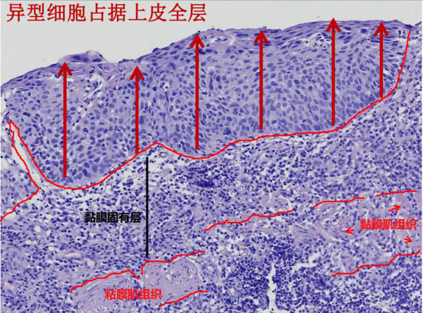  p data-id="gnwofb70aa">原位癌又称bowen氏病,或 a target="_blank"