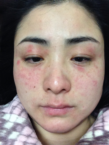 只对外界患者适应较差,容易因外部环境因素而导致出现各种症状如红疹