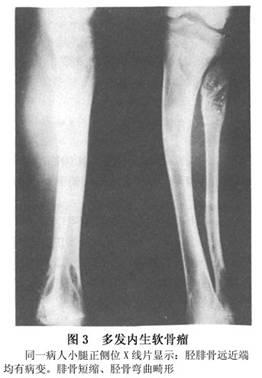 多发性遗传畸形性软骨发育异常