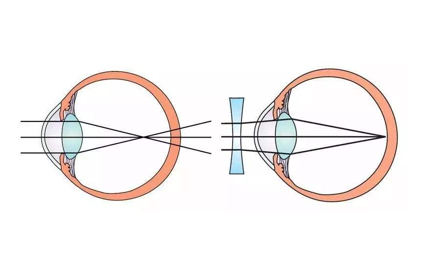  p>凹透镜是中间薄,边缘厚的透镜,对入射光具有发散作用.