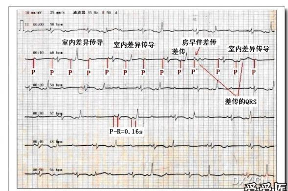  p data-id="gnwfwp2jx6">室内差异传导是一个在心脏专业医学角度,当 