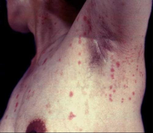  p> a href="#" data-lemmaid="10877738">异位性皮肤炎 /a>又称为" a