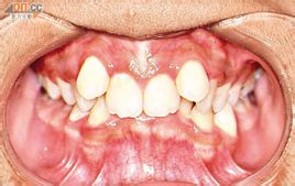  p data-id="gnwt9wlln0">锁颌是后牙的一种 a target="_blank" href=