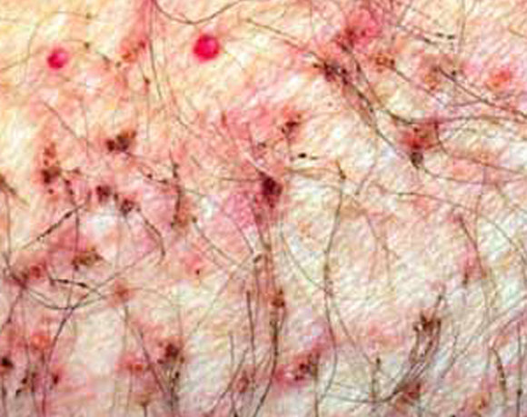 它一般是由 a target="_blank" href="/item/包皮龟头炎/1793528"