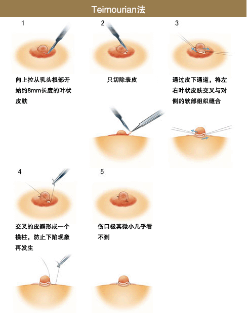 乳头内陷矫正