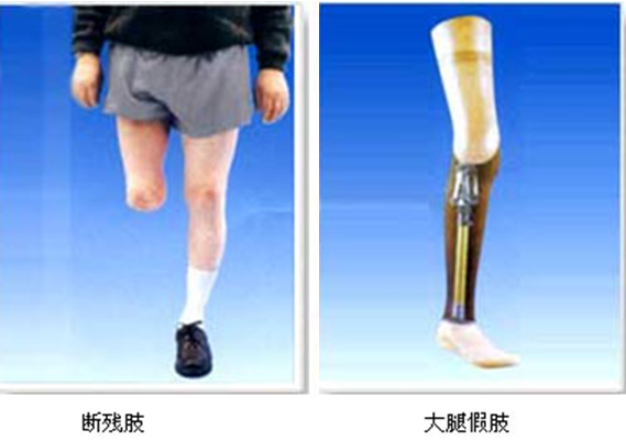 假肢