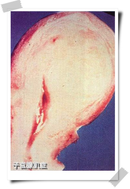  p>腺肌症是 a target="_blank" href="/item/子宫内膜异位">子宫内膜