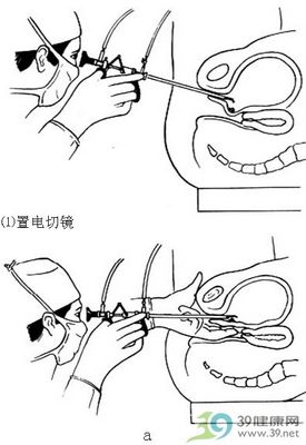  p data-id="gnax975blo">经尿道膀胱肿瘤电灼术,为膀胱手术的一种