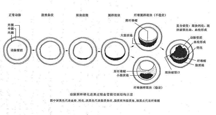 >,钙化季会壁血栓所形成粥样斑块可因内膜表面破溃而形成所谓粥样溃疡