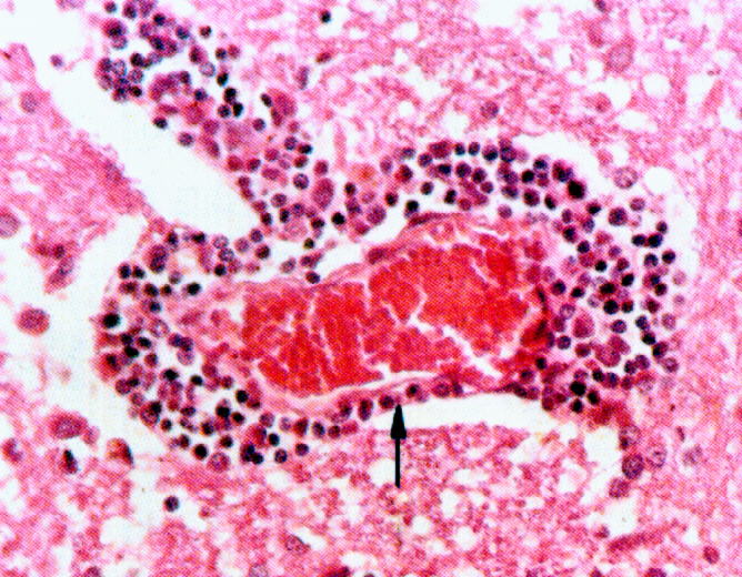 是一种 a href="#" data-lemmaid="3272733">肠病毒 /a>(enterovirus)