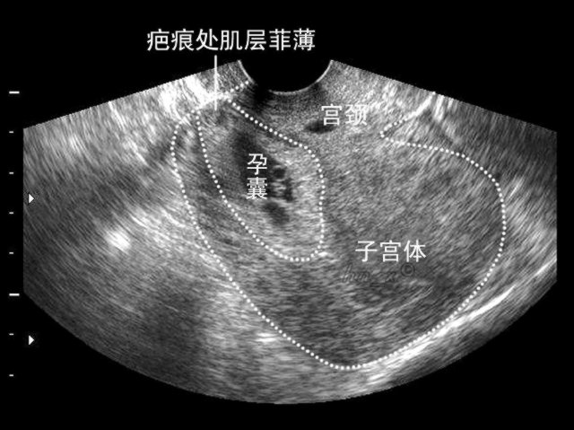 是指有过剖宫产史的女性,在再次妊娠的时候,孕囊着床在子宫原疤痕处
