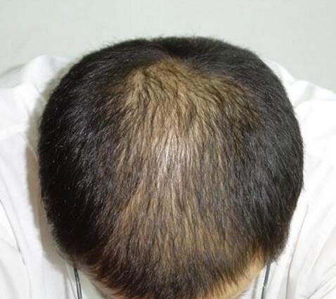  p>肾虚型脱发是由于肾虚造成的非正常脱发.