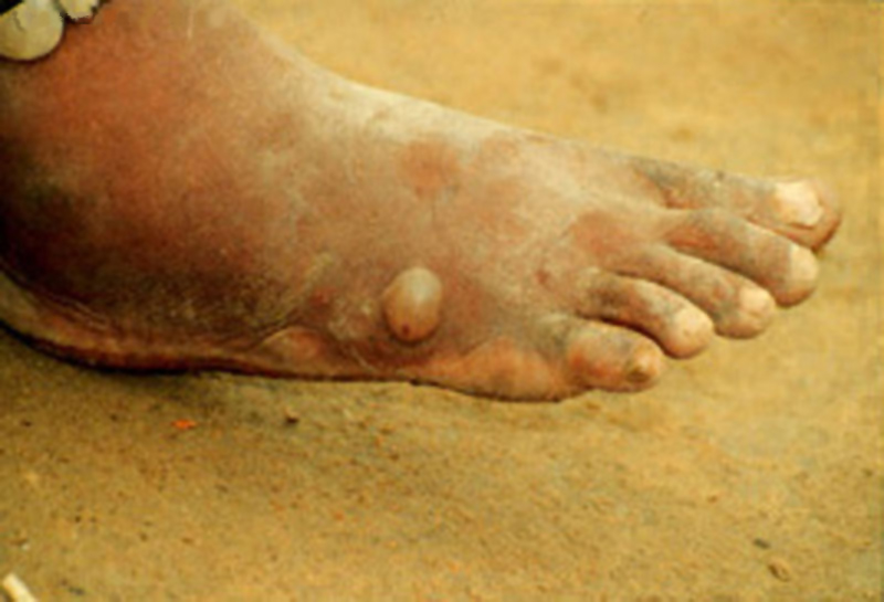  p>麦地那龙线虫 dracunculus medinensis,是唯一的主要由饮用水传播