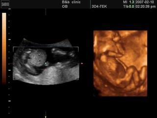  p>胎照是指利用 a target="_blank" href="/item/b超">b超 /a>对腹中