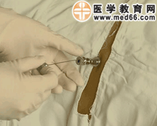  p>骨髓穿刺术(bone marrow puncture)是采取骨髓液的一种常用诊断