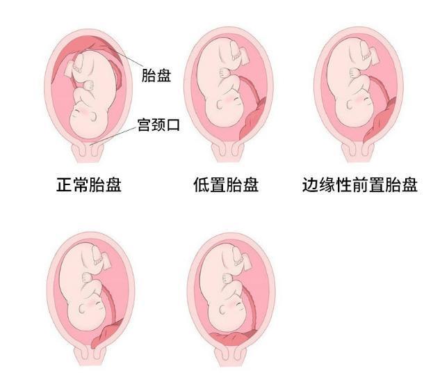 边缘性前置胎盘