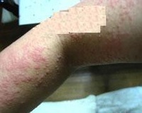 婴儿丘疹性肢皮炎