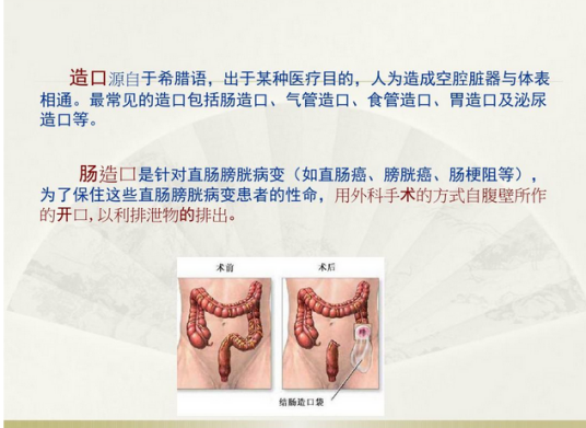 造口人_百度百科
