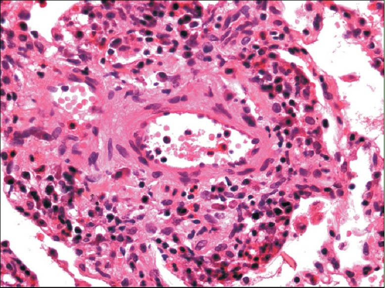 allergic granulomatosis with polyangiitis