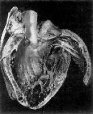 脱发掉甲病是由于石煤含硒量高所致的硒中毒;还证实缺硒是克山病的 a