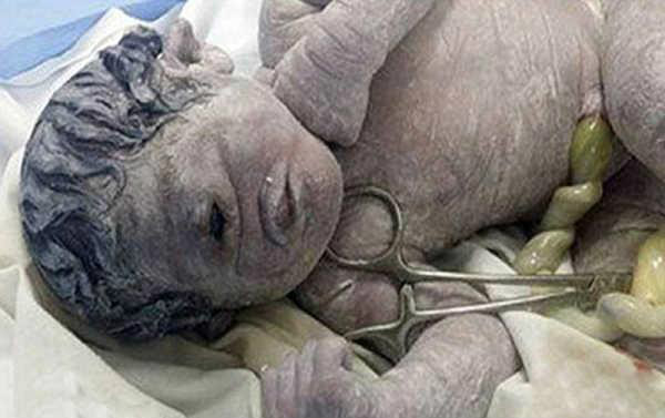 kswo">独眼婴儿是只有一只眼睛的婴儿,2015年10月6日在埃及私人医院el