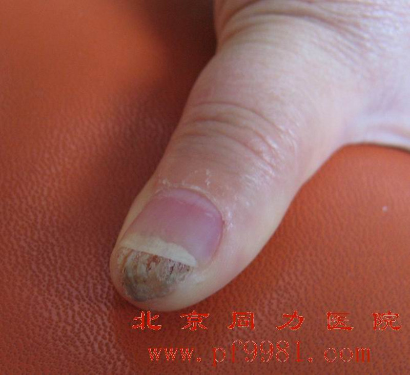  p>鱼痣即鱼鳞痣,究其本质不是一种痣,其实是一种 a target="_blank"