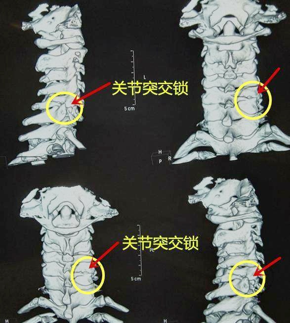 当存在颈椎不稳定时,移动的椎关节刺激交感神经,引起动脉痉挛,比如裹