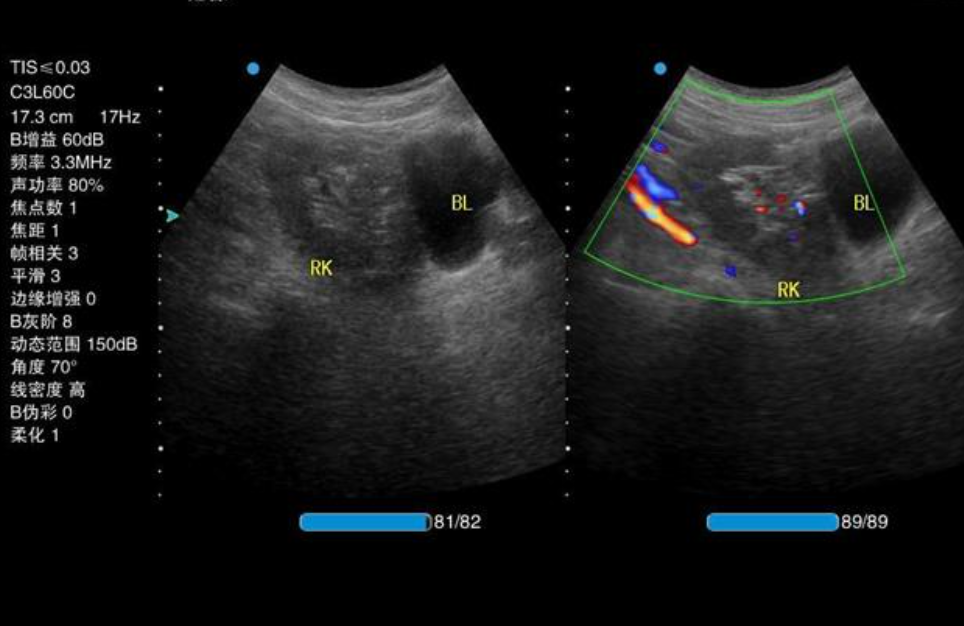 id="gnwsd1l5zj">其输尿管可通至同侧正常输尿管,或自行开口于膀胱