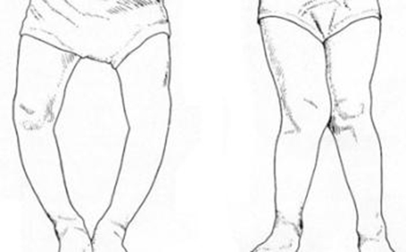 href="#" data-lemmaid="7934032">营养性维生素d缺乏性佝偻病 /a>