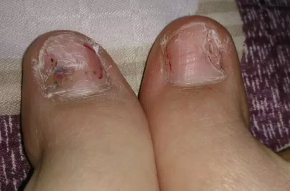 真菌感染型灰指甲