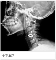 混合型颈椎病