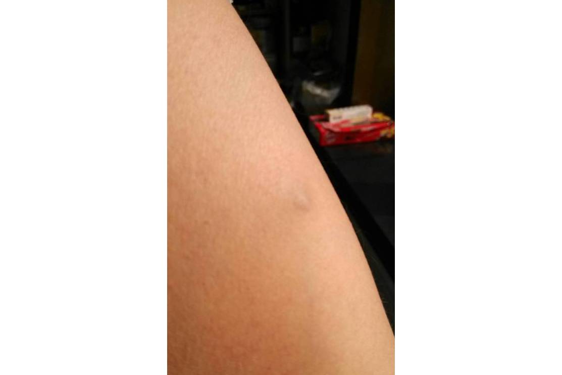 一种医学专业名词,是非正常的组织结构的包块,是一种疾病