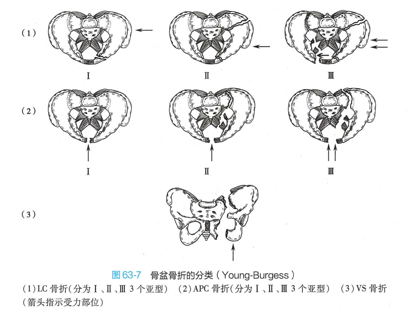 骨盆骨折