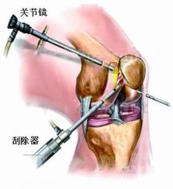 关节粘连松解灌洗术