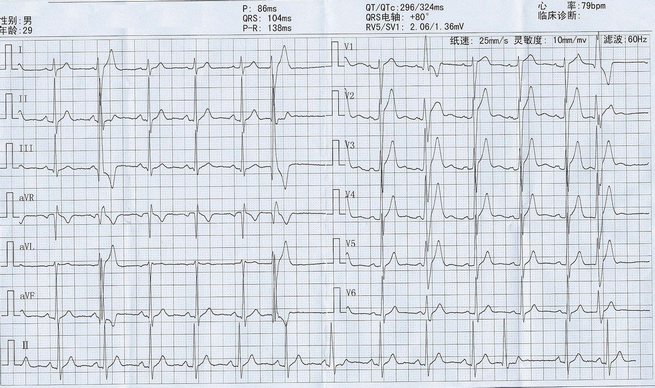 频发性室性早搏