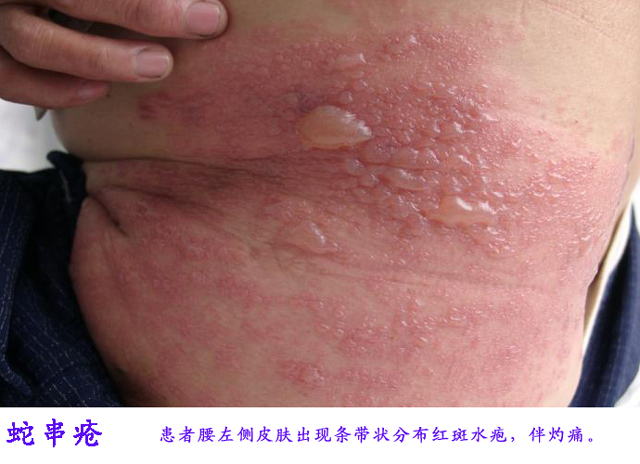 蛇串疮