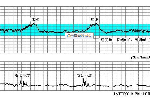 通过信号描记瞬间的胎心变化所形成的监护