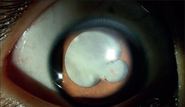 leucocoria,瞳孔区失去了正常的黑色而呈现白色的病态