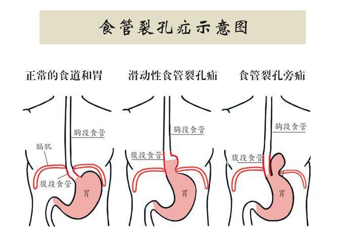  p data-id="gnwhkh74nu">食管裂孔位于 a target="_blank" href="