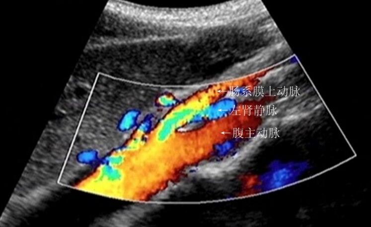  p>胡桃夹现象(nutcracker phenomenon)亦称左肾静脉压迫综合征,好发