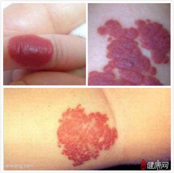  p>三叉神经血管瘤病是以面部血管痣,对侧局限性抽搐,偏瘫,智力低下等